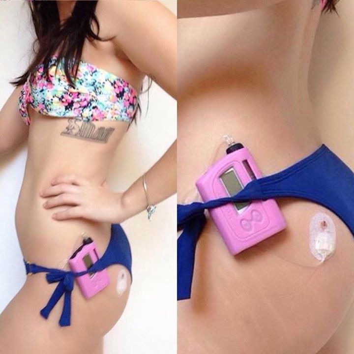 Marina mostrando como vestir um bikini mesmo sendo usuaria de bomba de insulina
