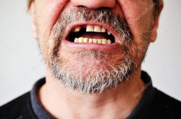 Estresse e ansiedade levam a aumento de dentes quebrados, dizem dentistas