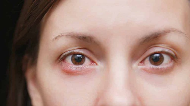 9 Perguntas e Respostas sobre o Terçol