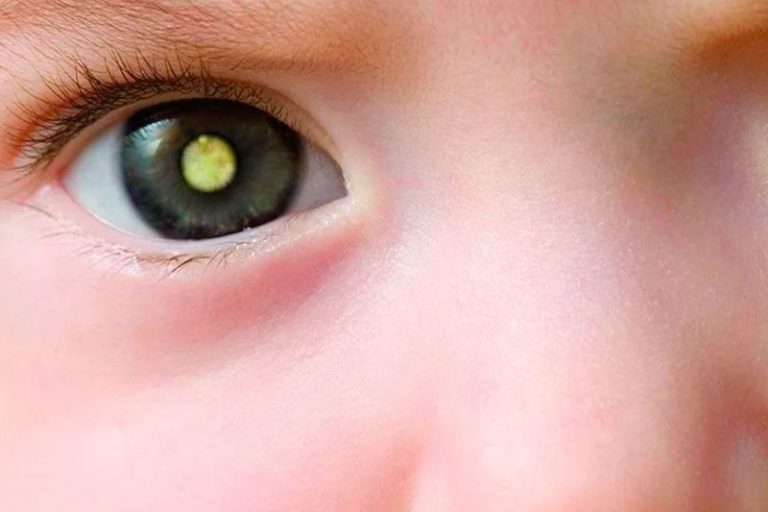 Teste genético confirma diagnóstico de retinoblastoma e reduz risco de mutação na próxima geração
