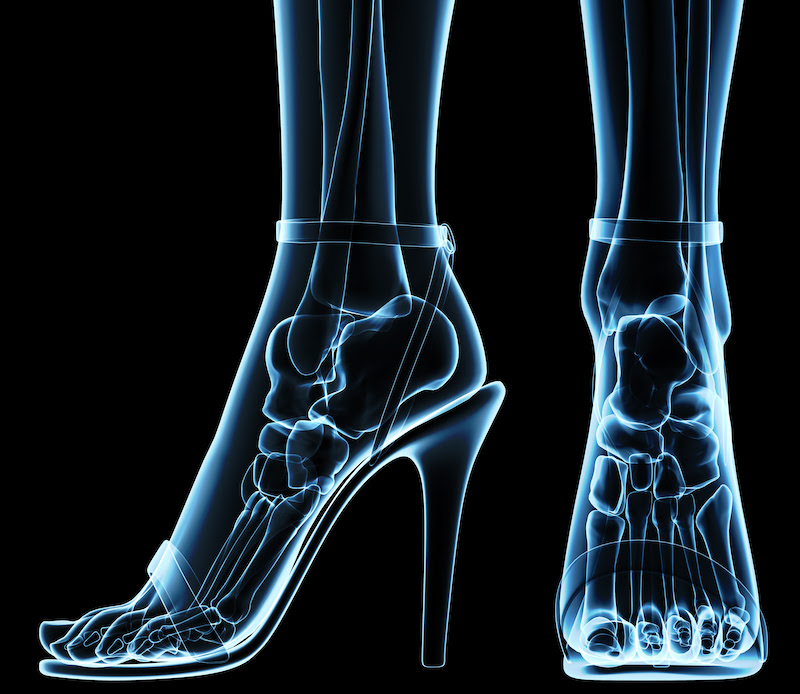 Estrutura óssea dos pés é sobrecarregada durante o uso de salto alto.