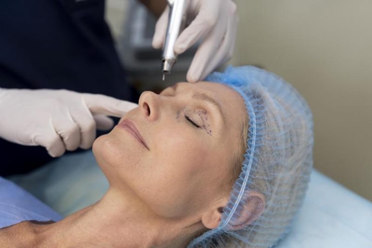 Busca por blefaroplastia estruturada com cortes a laser cresce pela recuperação rápida e resultados naturais