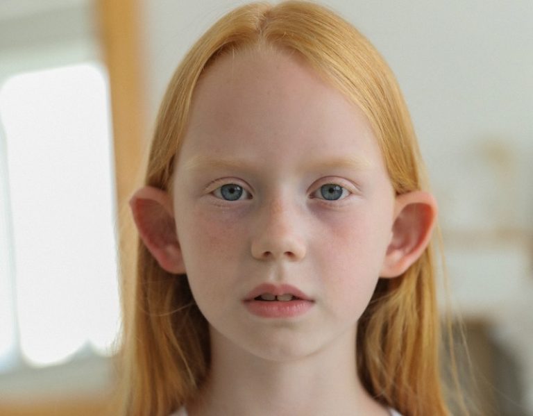 Orelhas de abano? A solução é simples!