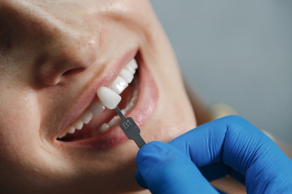 Aplicação de facetas dentárias exigem técnica especializado