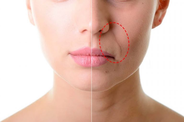 Bigode Chinês: como se livrar e evitar essas temidas rugas