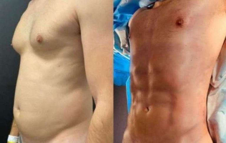 Os prós e contras da Lipo Lad feita pelo ex-BBB Caio Afiune; barriga trincada tem viralizado