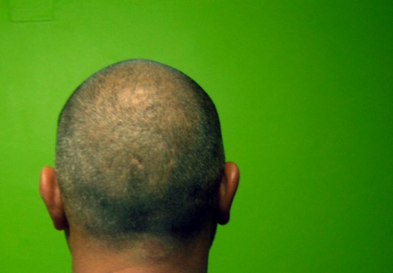 Salões de beleza apostam em novos tratamentos para retardar a calvície