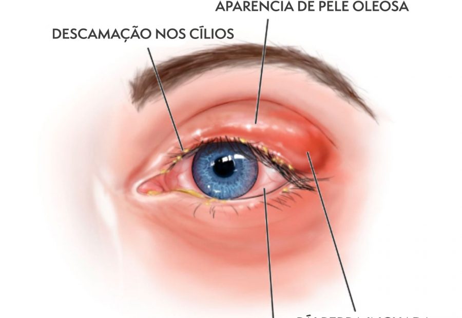 Aumento de Olho Seco por infestação de ácaros