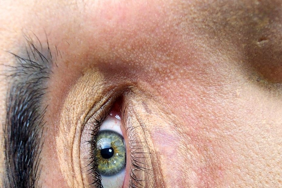 O que é camuflagem de olheiras e quais seus riscos?