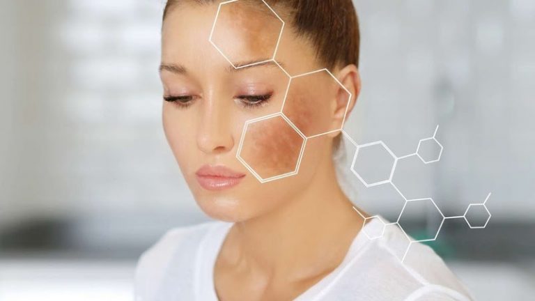 Melasma: novas tecnologias e tratamentos combinados apresentam resultados eficientes e duradouros