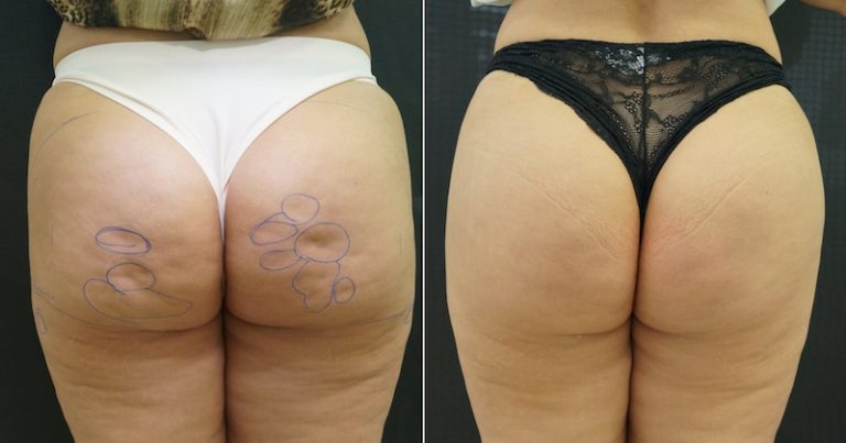 Cicatrizes cutâneas e celulites em graus severos têm resultado eficaz com método de tratamento avançado