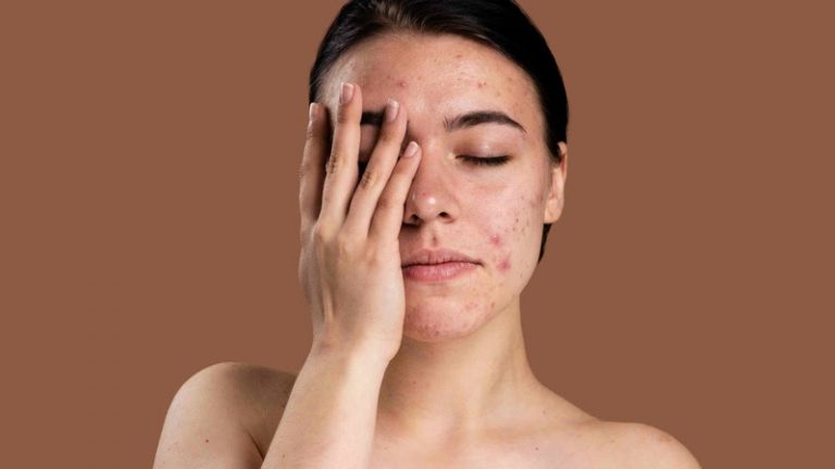 Acne inflamada: causas, tratamentos e cuidados para uma pele saudável