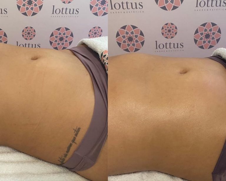 Drenagem linfática no pós-parto: especialista fala sobre procedimento realizado por Virginia Fonseca