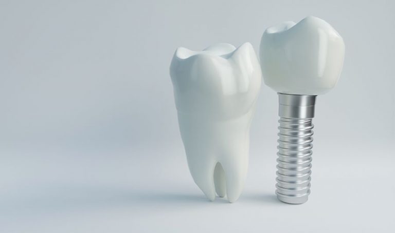 Conheça as técnicas mais utilizadas em implantes dentários