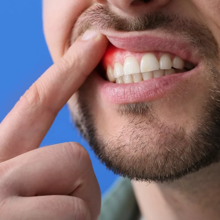 Doença Periodontal: saiba quais os impactos na saúde e como se prevenir