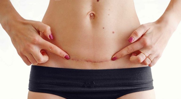 Cirurgia Plástica e Diabetes: Quais cuidados diabéticos precisam tomar para realizar uma cirurgia plástica?