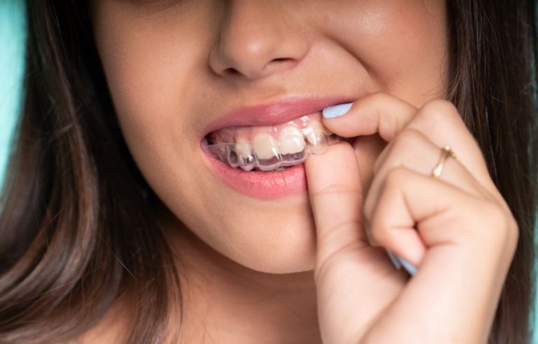 Alinhadores transparentes podem ser usados na prevenção de tratamento s mais complexos em crianças e adolescentes