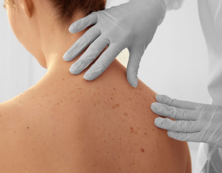 Câncer de pele: medidas preventivas seguem sendo essenciais durante o inverno