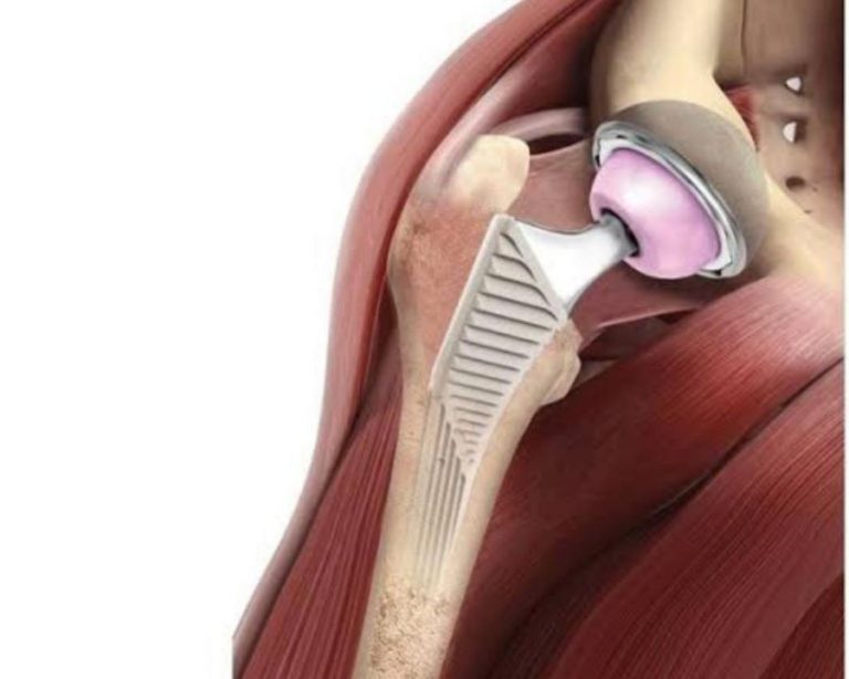 Santa Casa de Barretos é pioneira em nova abordagem cirúrgica para implantação de prótese de quadril