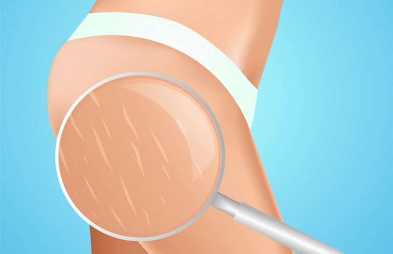 Estrias: Um Desafio Estético para os Amantes da Musculação