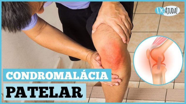O que é condromalácia patelar? Quais as causas e o tratamento?
