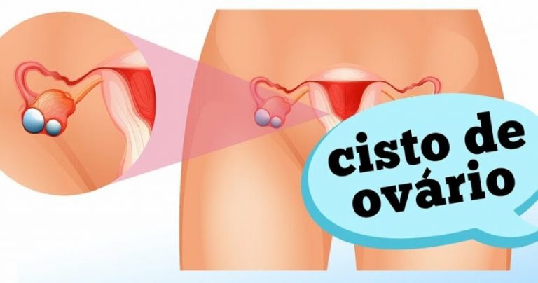 Quando se preocupar com um cisto de ovário?