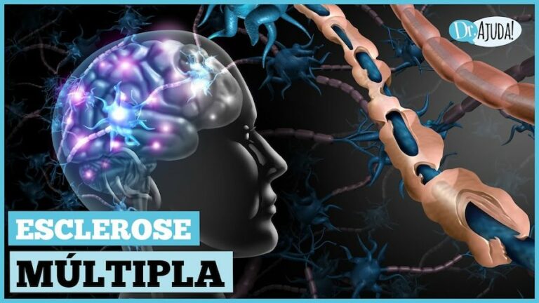 Sinais sutis da Esclerose Múltipla exigem atenção e podem ser confundidos com outras doenças