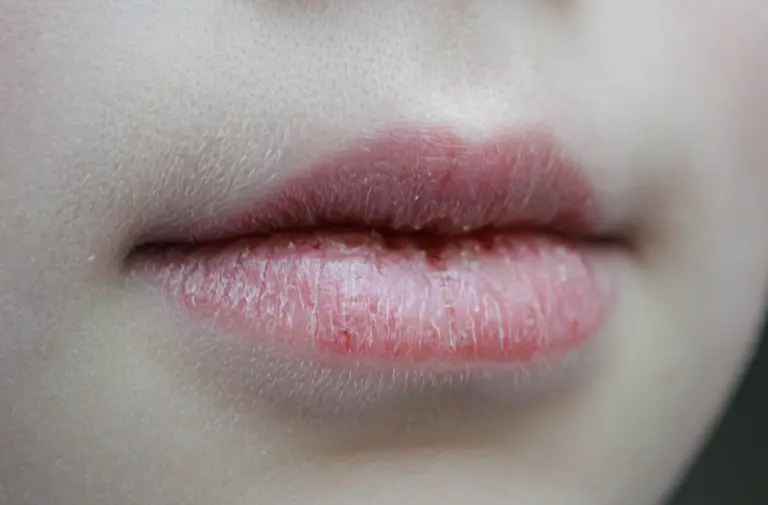 Lábios rachados no inverno: como evitar e tratar o problema comum da estação mais fria do ano