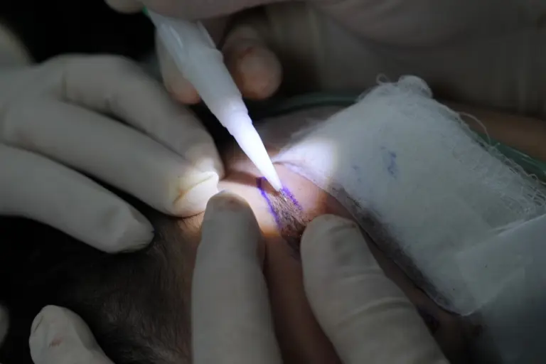 Por que as mulheres estão fazendo transplante de sobrancelhas? Saiba como é o procedimento