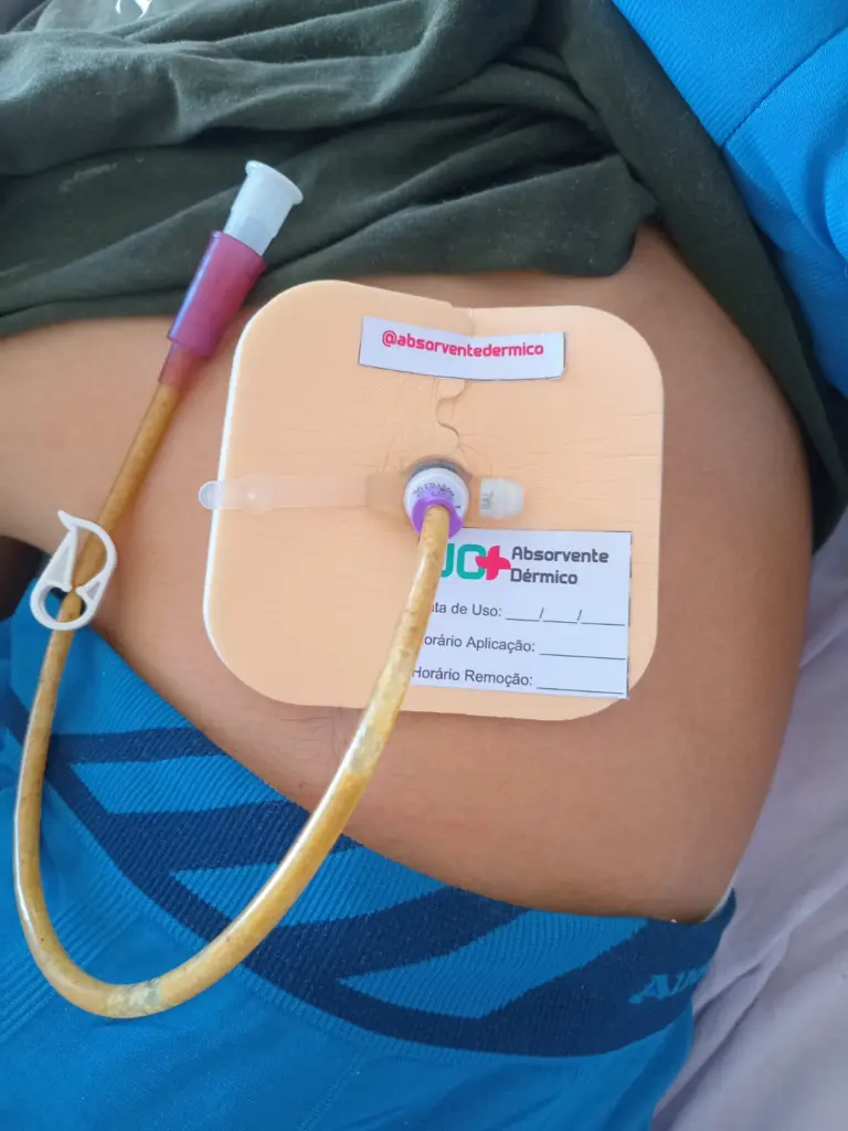Brasileira cria tecnologia inédita para reduzir complicações em pacientes alimentados por sonda