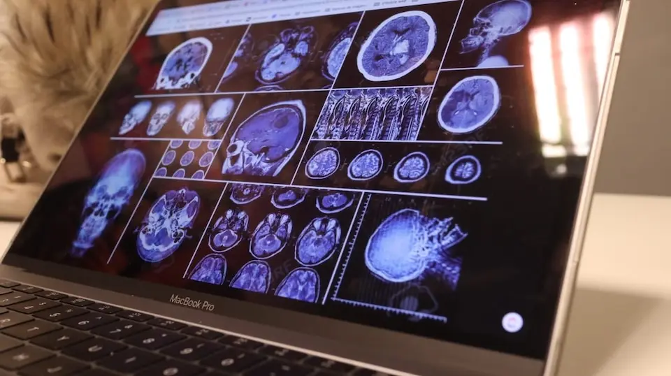 Imagens de ressonância magnética do cérebro analisadas com auxílio de Inteligência Artificial