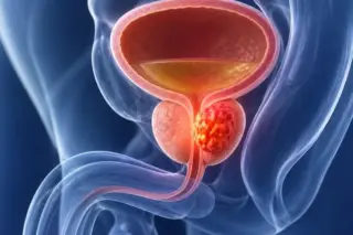 Ilustração médica da próstata com área tumoral destacada abaixo da bexiga