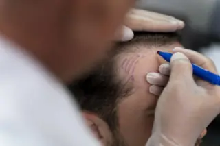 médico de luvas desenhando marcações na linha capilar de um paciente com caneta azul