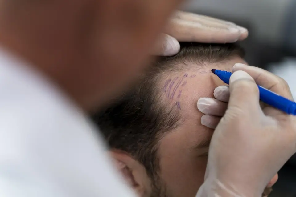 médico de luvas desenhando marcações na linha capilar de um paciente com caneta azul