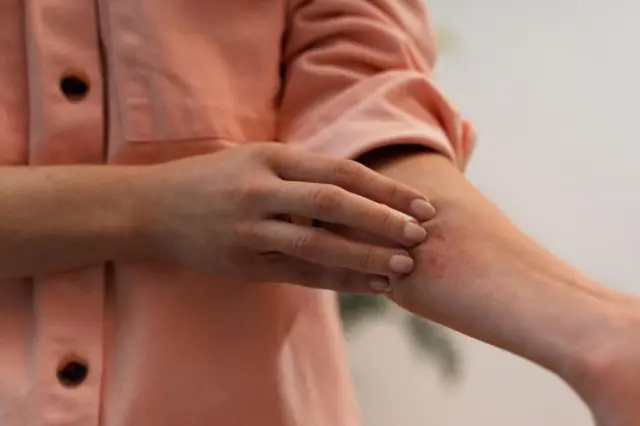 Mão coçando antebraço com vermelhidão e erupção cutânea; pessoa veste camisa rosa