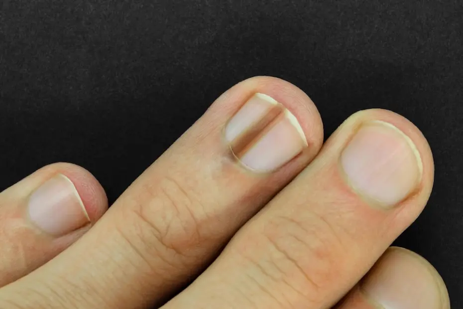 Melanoma sob a unha: cirurgia conservadora pode evitar amputação do dedo em casos selecionados