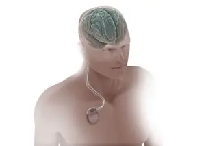 Torso humano semi-transparente com cérebro visível e um gerador de pulso no peito conectado ao cérebro por um eletrodo