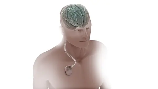 Torso humano semi-transparente com cérebro visível e um gerador de pulso no peito conectado ao cérebro por um eletrodo